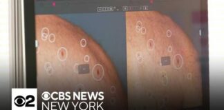 Cancer vaccine trial shows promise in treating melanoma